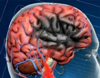 Acidente Vascular Cerebral